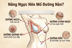 nen mo nang nguc duong nao